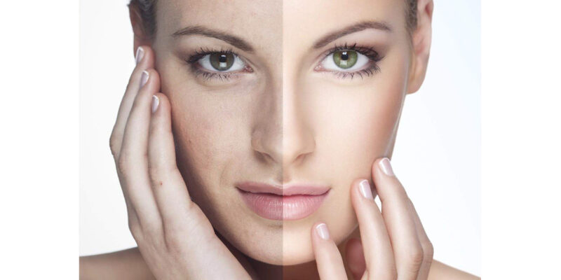 Filler Occhi Salerno