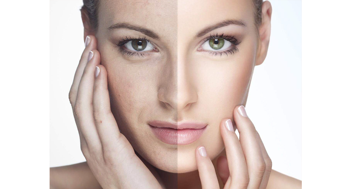 Filler Occhi Salerno