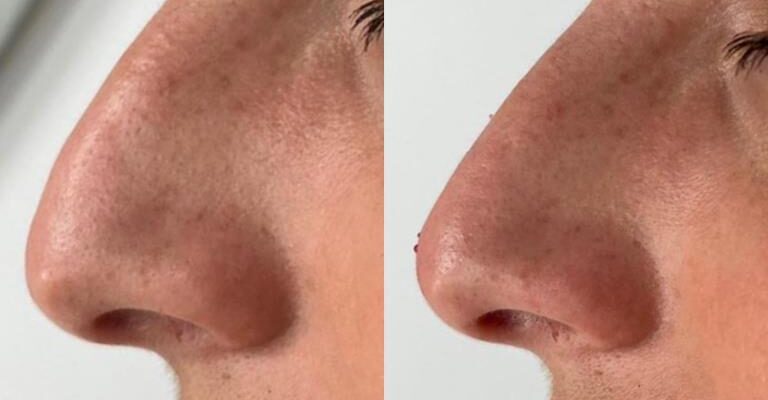 Filler Naso Salerno