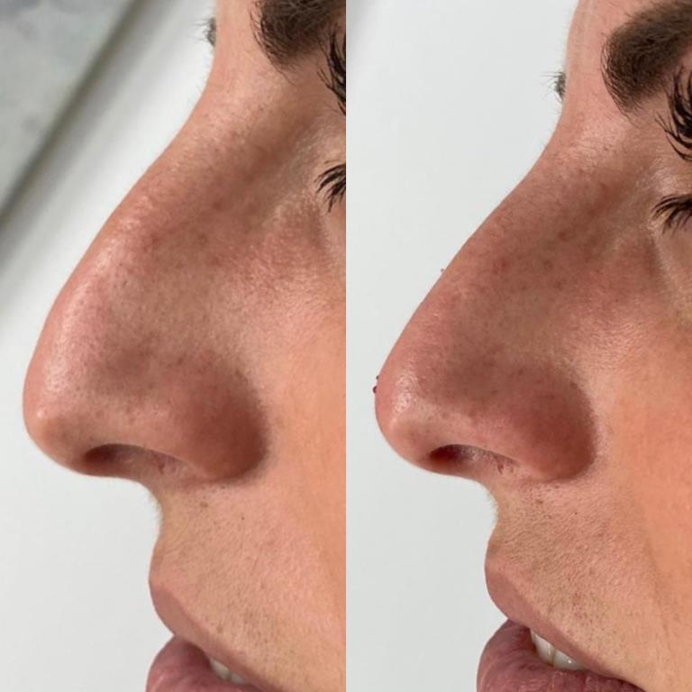 Filler Naso Salerno